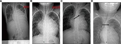 Pulmonary artery aneurysm caused by infective endarteritis attributed to patent ductus arteriosus in children: a case report and literature review